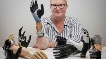 Η πρώτη «βιονική» γυναίκα στον κόσμο διαθέτει ρομποτικό χέρι που «ενσωματώνεται» στον σκελετό