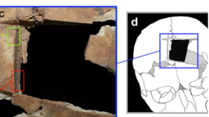 Άνθρωπος με τετράγωνη τρύπα στο κρανίο: Ένδειξη για χειρουργική εγκεφάλου πριν 3.500 χρόνια στο Ισραήλ