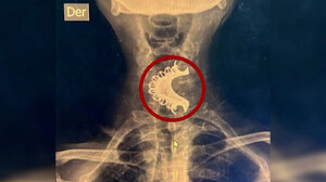 Ηλικιωμένος άνδρας που κατάπιε κατά λάθος τη μασέλα του χειρουργήθηκε επιτυχώς 