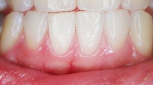 12 αιτίες που υποχωρούν τα ούλα