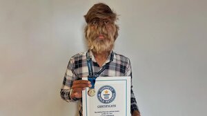 Έφηβος με το σύνδρομο του λυκάνθρωπου μπήκε στο Guinness 