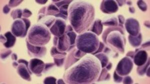 Σημαντική αύξηση στους ασθενείς με πρώιμο στάδιο καρκίνου του στομάχου