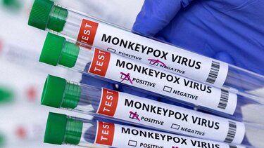 Ιταλός διαγνώστηκε ταυτόχονα με κορωνοϊό, ευλογιά των πιθήκων και HIV 