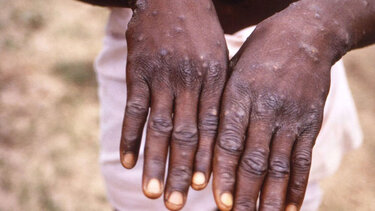 Εξαπλώνεται ανησυχητικά στην Ευρώπη η ευλογιά των πιθήκων 