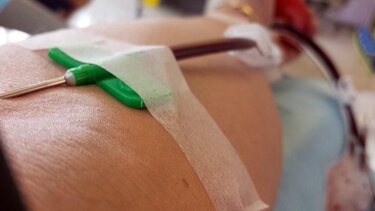 Νέα εξέταση αίματος ανιχνεύει με ακρίβεια τον καρκίνο του παχέος εντέρου