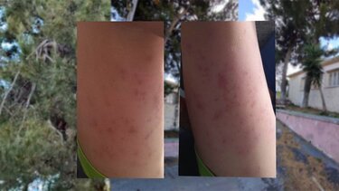 «Το παιδί μου ανέπτυξε αλλεργίες από τα πεύκα, έξω από το σχολείο του»