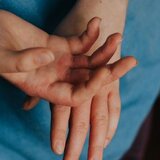 Κρούσματα ψώρας σε σχολείο του Ηρακλείου! Σε κινητοποίηση οι αρχές